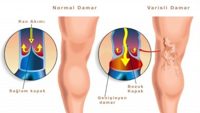 Photo of BU KARIŞIMI KULLANARAK VARİSLİ DAMARLARDAN SONSUZA DEK KURTULUN