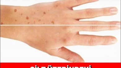 Photo of Cilt Üzerindeki Benler nasıl Yok edilir..