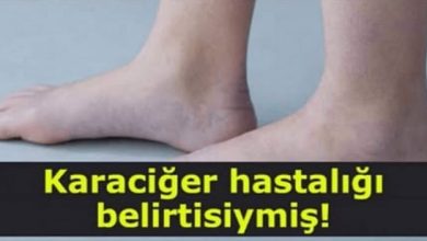 Photo of MEĞERSE KARACİĞER HASTALIĞI BELİRTİSİYMİŞ