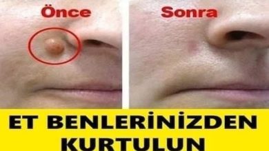 Photo of Et benleri tedavi