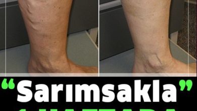 Photo of Varisli Damarlardan Kurtulma